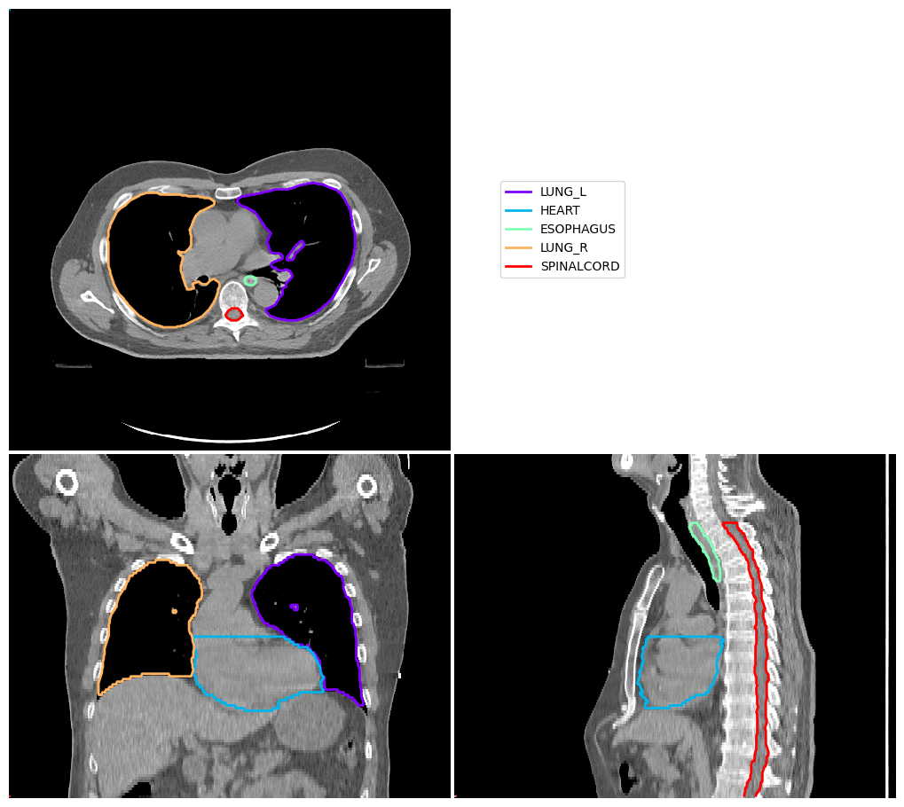 ../_images/_examples_atlas_segmentation_10_0.png