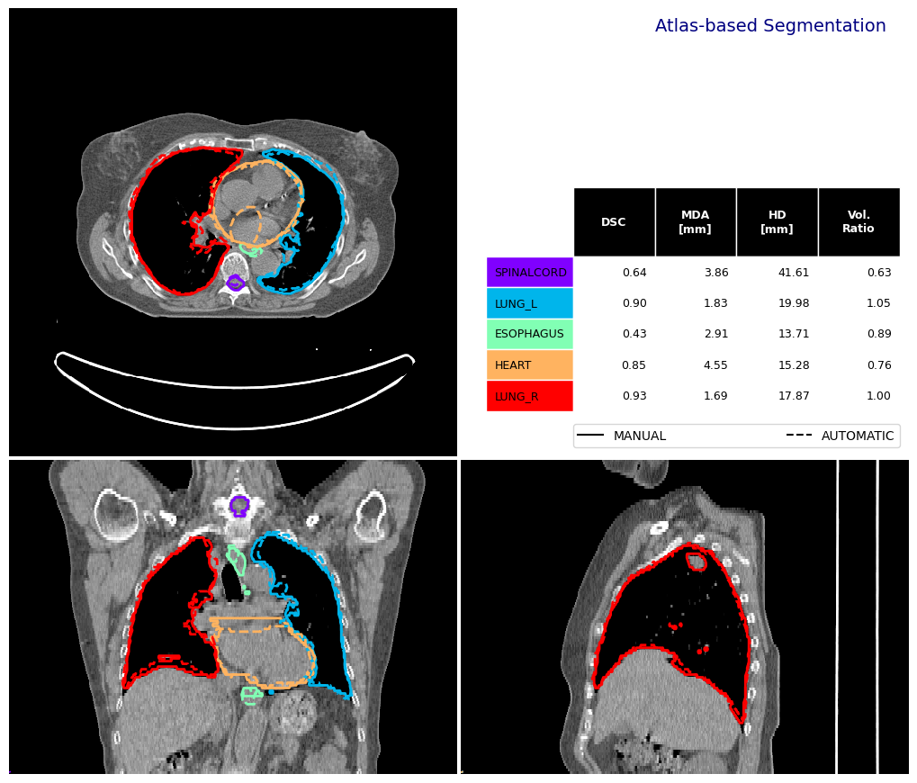 ../_images/_examples_atlas_segmentation_18_1.png