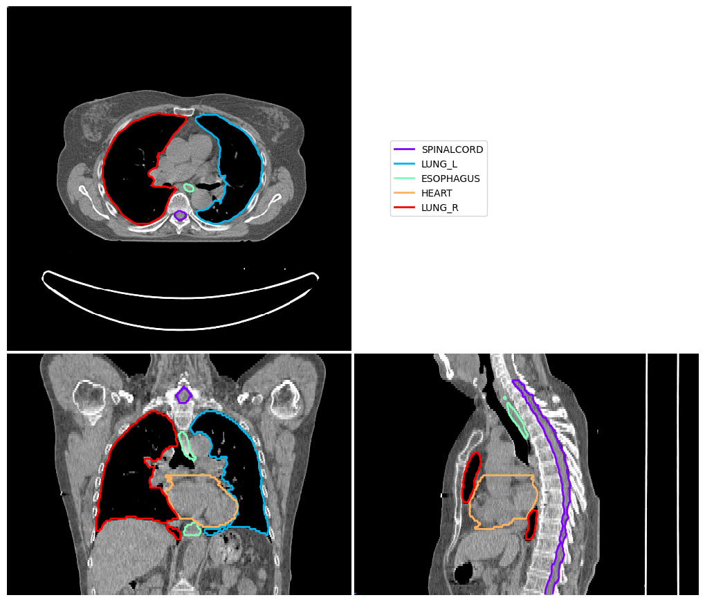 ../_images/_examples_atlas_segmentation_9_0.png